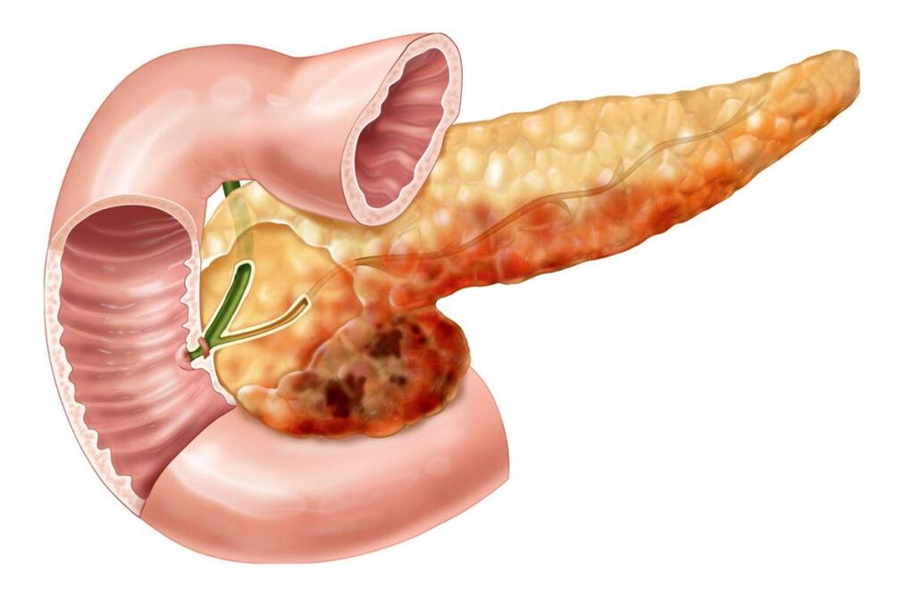 Mal di schiena dovuto alla pancreatite