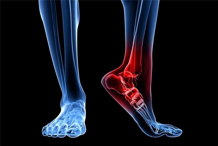 artrosi del piede