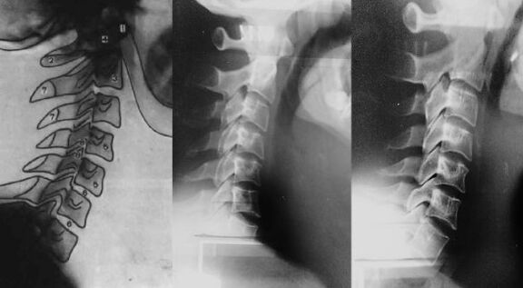 Collo con uno spostamento della prima vertebra cervicale