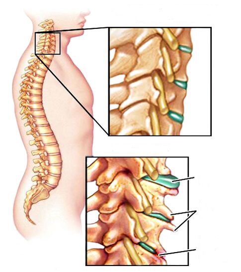 Come appare l'osteocondrosi