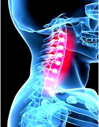 Immagine clinica dell'osteocondosi