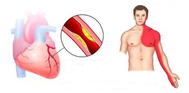 Sindrome cardiale